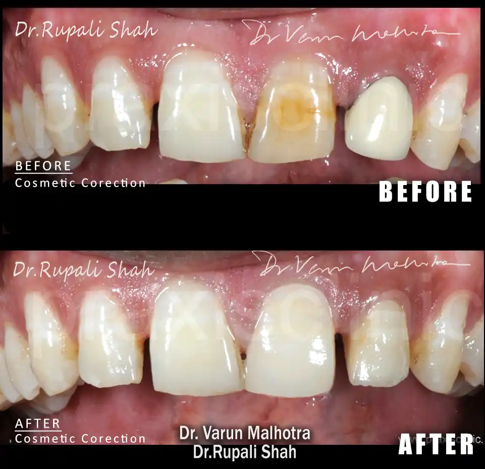 Full Mouth All-on-8 Implant by the best dentist for dental implants in Mumbai 